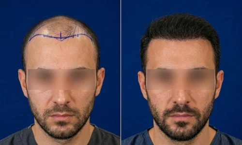 hairtransplant kus adasi